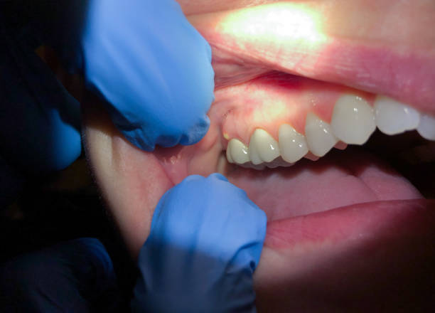 Best Emergency Wisdom Teeth Removal in Alpena, MI