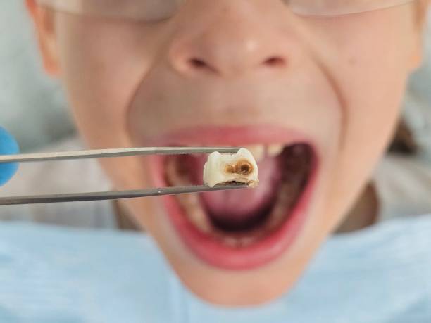 Best Emergency Treatment for Dental Infections or Abscesses in Alpena, MI