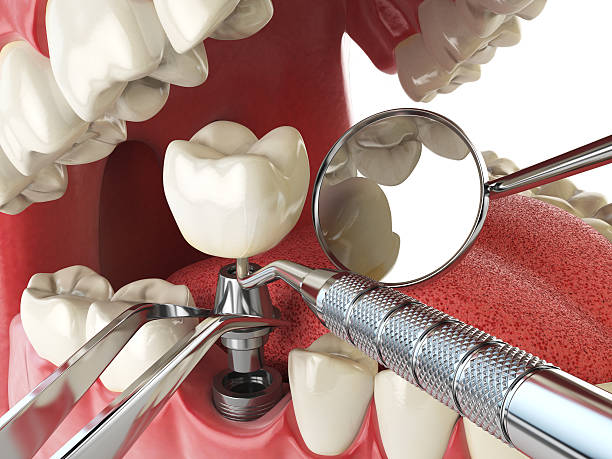 Best Emergency Dental Care for Broken or Chipped Teeth in Alpena, MI